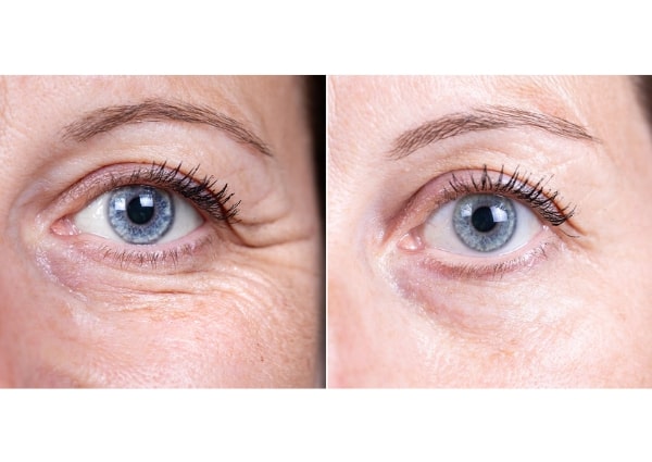 botox-under-eyes before after results